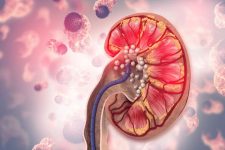 Non-Surgical Treatment for Kidney Stones_ Exploring Effective Options